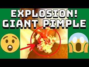 Giant Pimple Explosion Cyst Popping | Acne Pus Blackheads Bursting | ASMR Satisfying 35# 😱😱😱