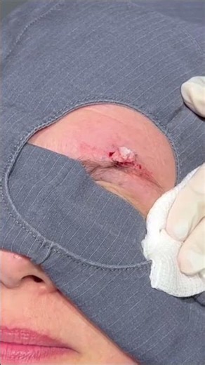 Forehead Cyst Removal