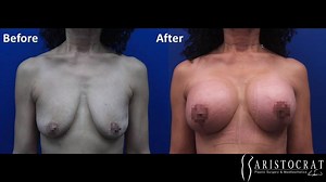 3 Month Post Op: Breast Lift Augmentation with IDEAL Saline Implants by Dr. Kevin Tehrani