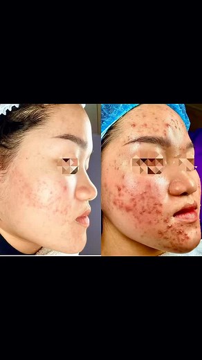 1️⃣ WHAT IS ENDOCRINE ACNE? Hormonal acne appears due to hormonal changes inside the body, common in: ✅ Puberty, pregnancy, perimenopause. ✅ People who tends to eat greasy, sweets, and/or spicy foods ✅ People who are often stressed, insomnia, and lack of exercising Hormonal acne often grows in the chin, jaw, cheeks and tends to become red, swollen and painful. If not handled properly, bacteria can spread and make the skin condition more serious. 2️⃣ HOW TO TAKE CARE OF YOUR SKIN PROPERLY TO AVOI