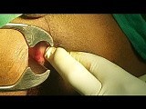 Closed Lateral Internal Sphincterotomy • Video • MEDtube.net