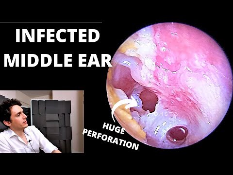 The Worst Ear Infection (Suppurative Otitis Media)