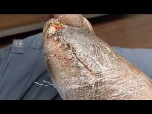 CASE UPDATE: THE GANGRENOUS TOE / PARTIAL FOOT AMPUTATION AND MAYBE ANOTHER ON THE WAY 😢😢😢😢