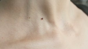 Tick Crawling On Human Skin Wood Stock Footage Video (100% Royalty-free) 17152414 | Shutterstock