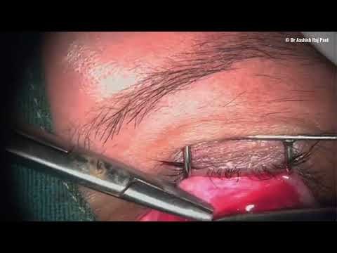 Optic nerve sheath fenestration surgery (optic nerve sheath decompression)