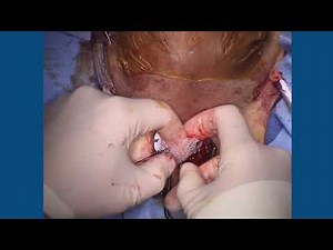 Placement of the AdVance™ XP Male Sling System