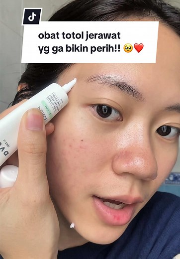 Obat Totol Jerawat yang Ampuh dan Tidak Perih