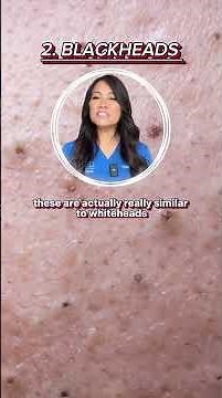 Most "Poppable" Pimples are Pustules, But...