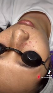 6.5K views · 28 reactions | LASER SYRINGOMA/WARTS/MILIA REMOVAL...