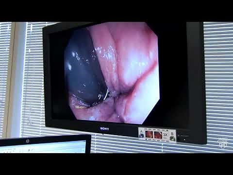 Mayo Clinic Minute: What you need to know about polyps in your colon