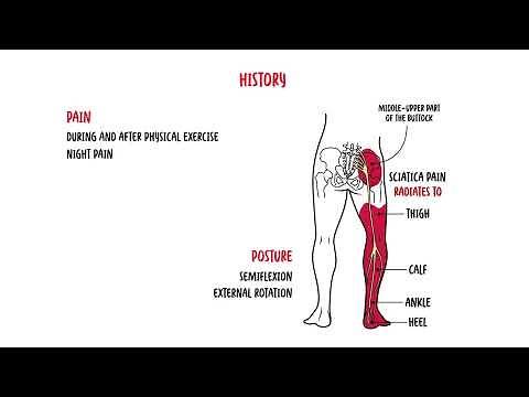 Piriformis Syndrome (buttock pain, siatica)