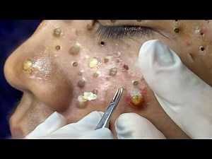 Pimple Popping Satisfying Video : Impressive Blackheads & Cyst Extractions #pimplepopping #acne #124