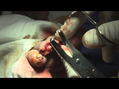 Emergency Management of Amputated Toes (Viewer Discretion Advised)