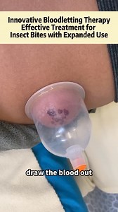 Conventional medication can be a prolonged process when treating...