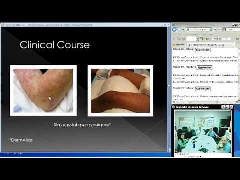 Stevens-Johnson Syndrome. (Christopher Miller, MD)