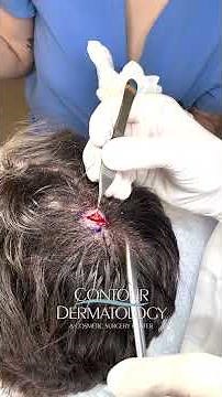 DOUBLE Scalp Cyst Showdown ⚡ Satisfying Pop Finale!