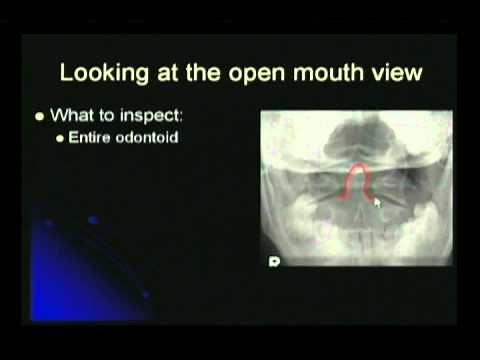 Cervical Spine Mouth View