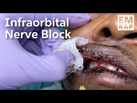 Infraorbital Nerve Block