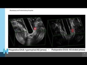 Ultrasound-guided Lateral Internal Sphincterotomy. A Video Vignette