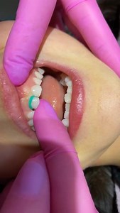 3 comments | And when the tooth of milk doesn't fall out, can we...