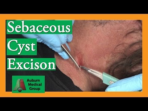 Sebaceous Cyst Removal | Auburn Medical Group