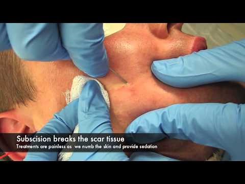Subscision and surgery for acne scars