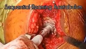 Anterolateral Approach to Hip