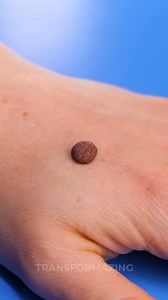 Cryotherapy for mole removal – step by step 💉📘 | Transformazing