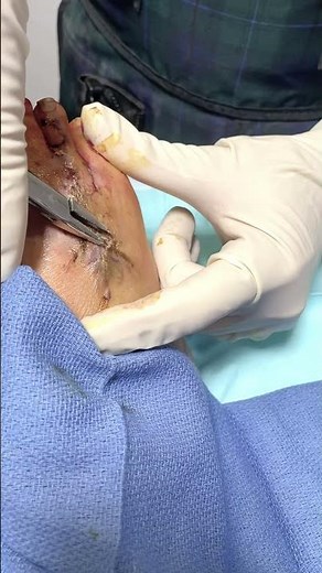 The Most Satisfying Scab Removal Experience