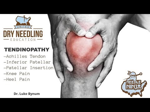 Tendinitis and Tendinopathy Dry Needling Treatment Protocol