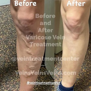 Before and After Varicose Vein Treatment images. Call 716-839-3638 to schedule an appointment for treatment. www.VeinsVeinsVeins.com @veintreatmentcenter on Instagram Microphlebectomy for varicose veins. Large veins like this are treated with microphlebectomy. Smaller veins and spider veins are treated with sclerotherapy. The decision to use one technique or the other or both depends on the size of the veins and on examination and venous ultrasound imaging as well@as vein mapping. This is done a