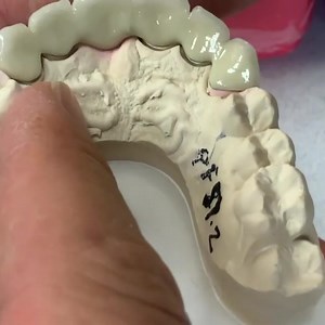 6-Unit Metal Ceramic Anterior Bridge, with a shade tab provided from the Doctor! Case from Dr. Lynn Malone in Illinois. | CEO Luke Kahng | Facebook