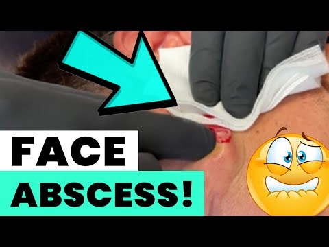 FACE ABSCESS!