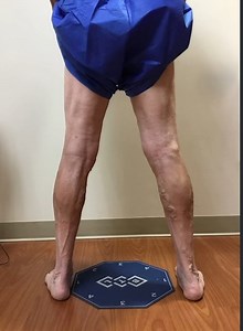 Struggling with varicose veins? EVLT targets the root cause, while ultrasound-guided sclerotherapy clears remaining problem veins for optimal results. Get the relief you deserve! 💙 #VeinTreatment #EVLT #Sclerotherapy #HealthyCirculation | Laser Lipo and Vein Center