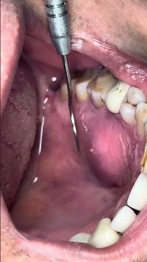 Tooth Abscess Treatment | Dental Procedure Close-Up