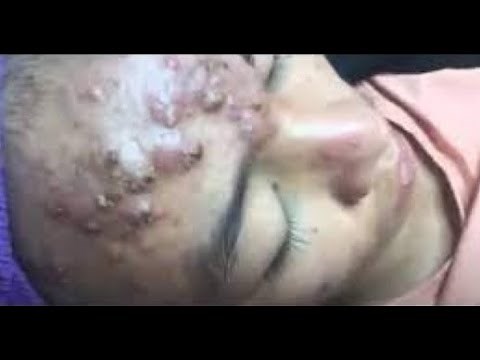 The Most Extreme Blackhead Popping Videos of 2023 | satisfying | blackheads | pimple