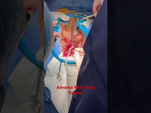 Advance male sling system. Treatment of male urinary incontinence.