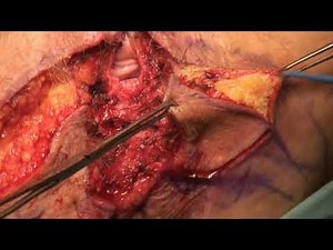 VULVAR RECONSTRUCTION WITH FLAP FOR CARCINOMA