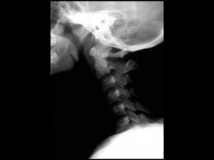 Hangman's Fracture on X ray