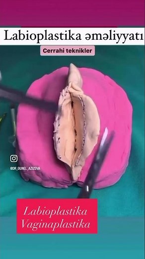 From dr Gunel-Azizova Labioplasti surgery عملية قص الشفرات تحت التخدير الموضعي ✨