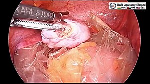 Dermoid Ovarian Cystectomy by Laparoscopy