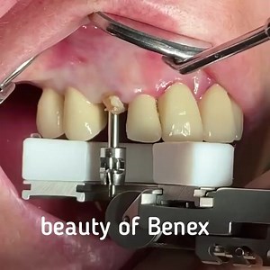 By• @dr.eik.schiegnitz the beauty of Benex 🦷 - minimal invasive tooth extraction 🧨🚀. Especially indicated in immediacy protocols. #implantdentistry #implantsurgery #implantology #dentalimplants #dentalimplant #implantologist | Dentistry blog
