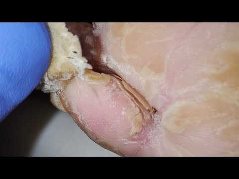 Skin Peeling, Flakes, Earwax