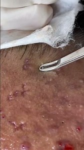 HUGE EXTRACTION #blackheads #acne #satisfying