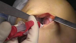 Femoral Condyle Cartilage Restoration Procedure Using a Cryopreserved Fresh Osteochondral Allograft