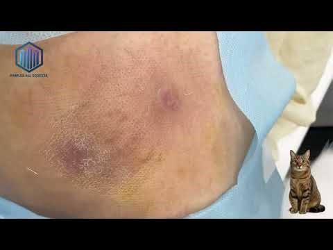Huge Inflamed Cyst and Zit Removal – Don’t Watch While Eating! #66 #funny #cat #cute #cyst