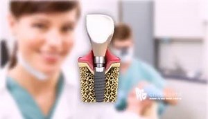 The importance of conical connection | Aesthetic Dentistry