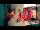 Simultaneous Heart and Liver Tumor Removal  • Video • MEDtube.net