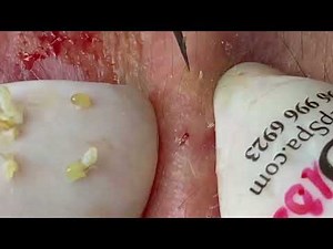 Huge Cyst & Pimple Popping That Shocked Everyone!
