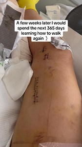 3.3K views · 5.1K reactions | That White Rabbit took me down an adventure I had never planned for, and it took every ounce of me to survive it. #AdventureTime #life #lifelessons #whiterabbit #rabbit #brokeleg #lifechanging #lifechangingmoments | Esmi Thomas | Facebook